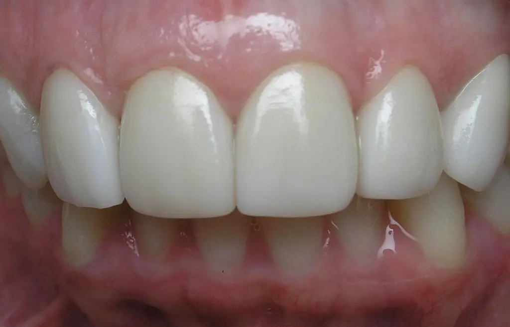 Dental veneers case 1 after