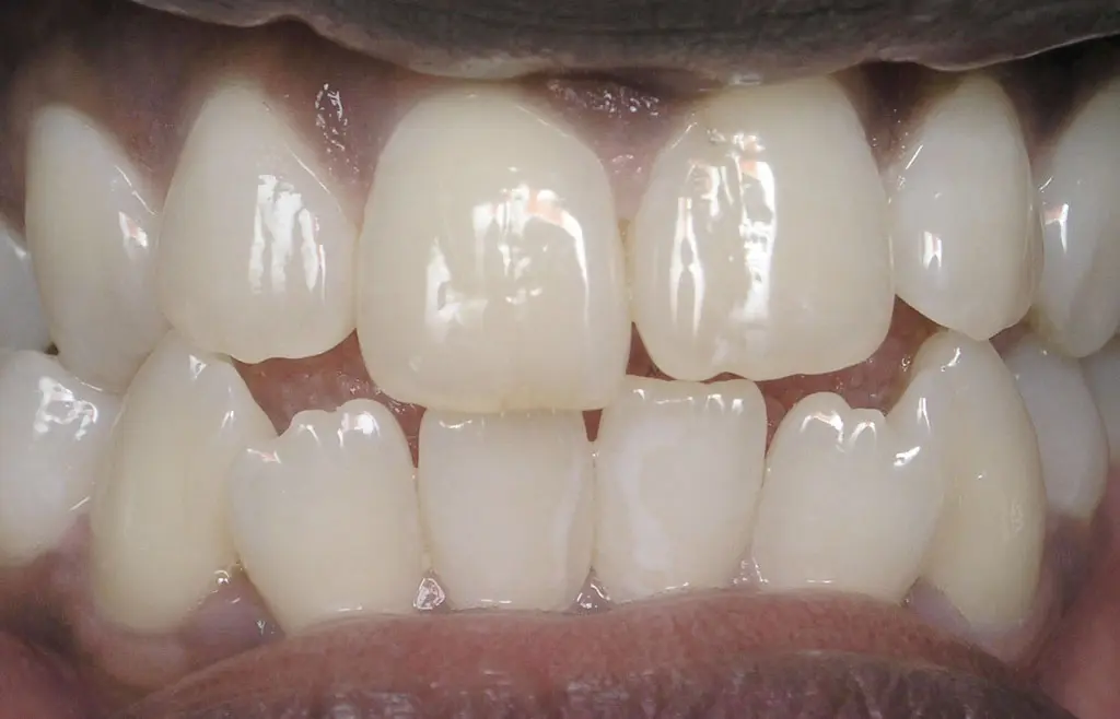 Orthodontics case 1 before