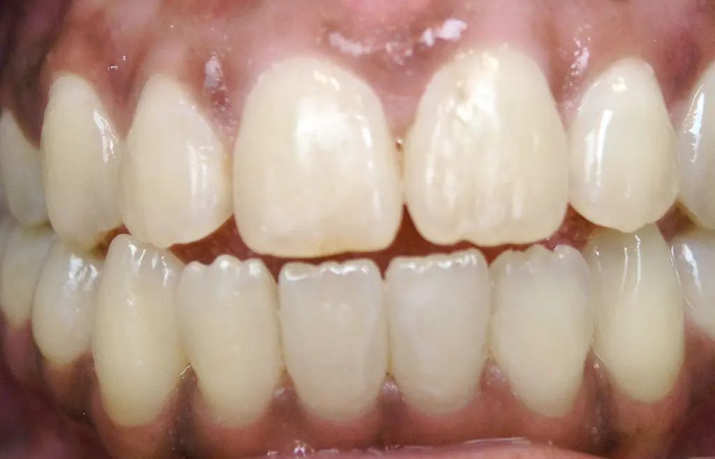 Orthodontics case 1 after