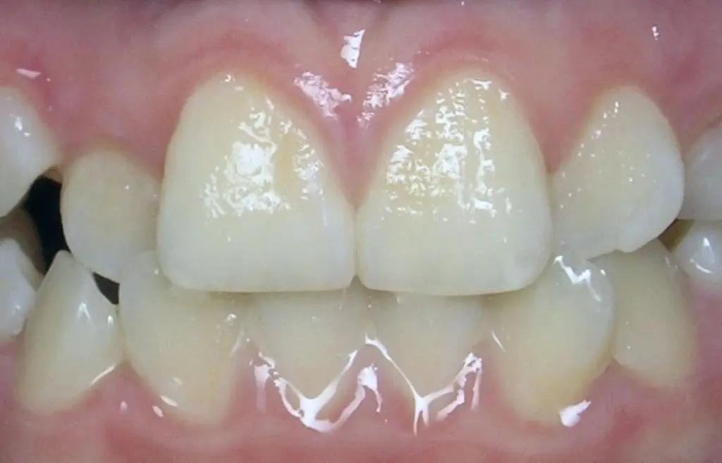 Orthodontics case 2 before