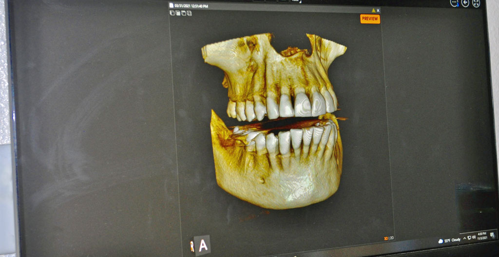 3D bone structure image of the maxilla and mandible