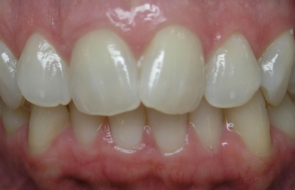 Profile image of a person's teeth before dental veneers
