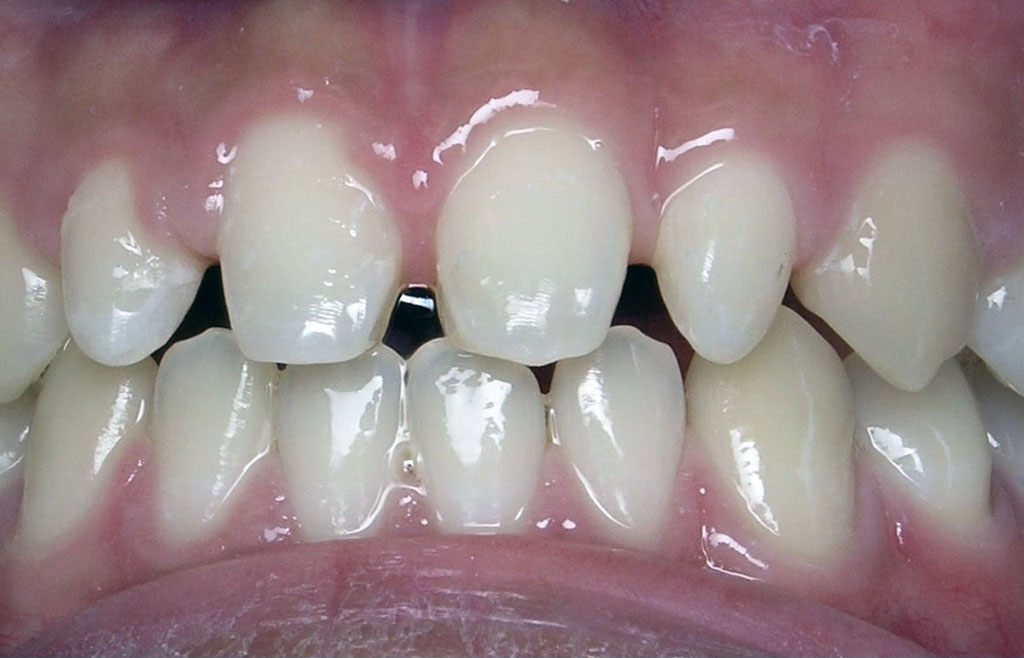 Image of dentistry patient's teeth before dental veneers