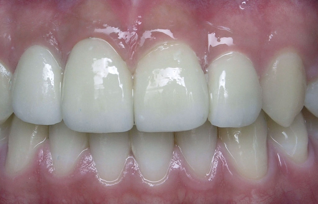 Image of dentistry patient's teeth after dental veneers were applied