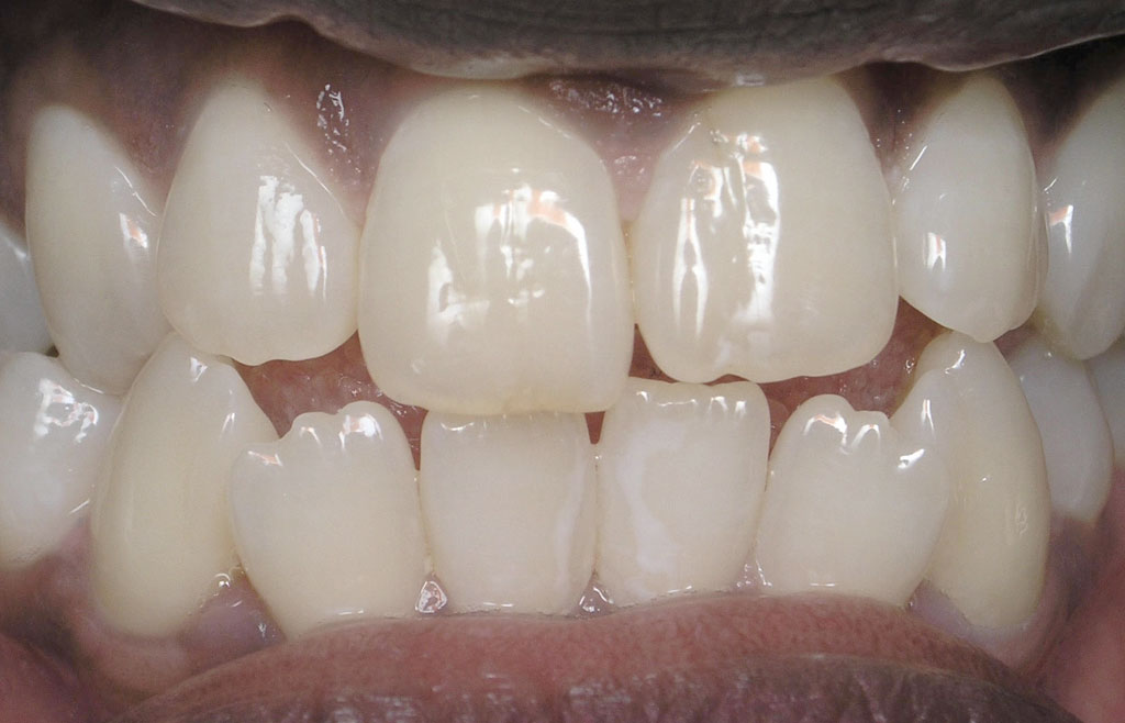 Image of teeth taken before orthodontic treatment