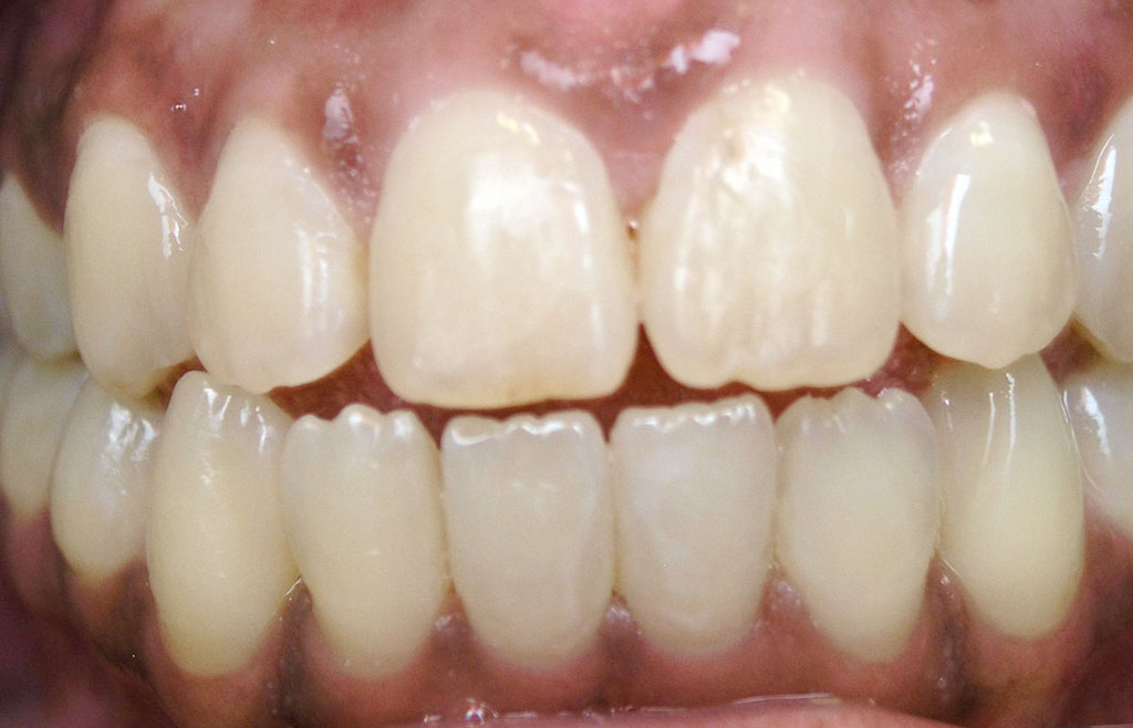 Image of teeth after orthodontic treatment