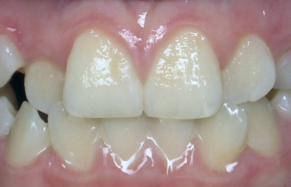 Image of dentistry patient's teeth before orthodontics treatment