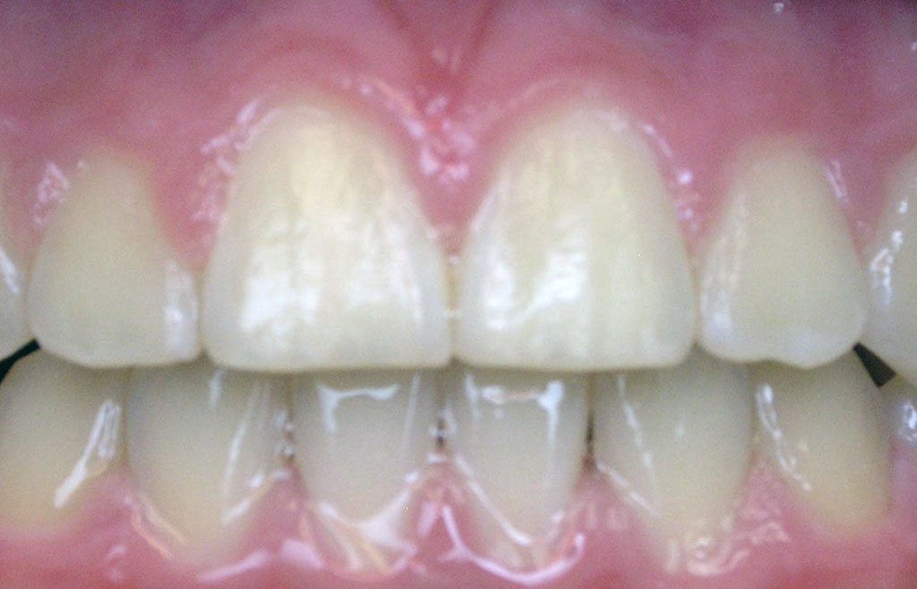 Image of dentistry patient's teeth after orthodontics treatment