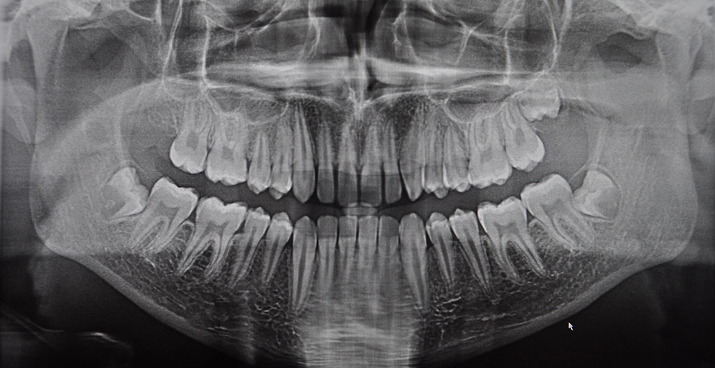 Black and white x-ray image of a persons full set of teeth