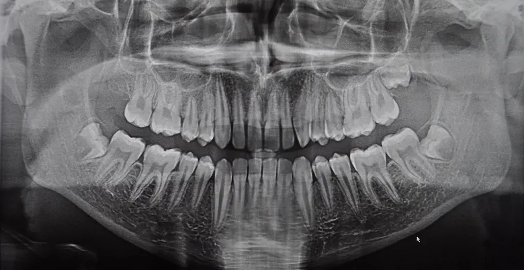 Panorex x-ray at Stone Oak Family Dentistry